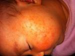 Сыпь на лице месячного ребенка фото 1