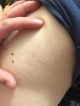 Сыпь на теле у 4х летнего ребёнка фото 2