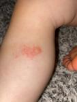 Красноватое с мелкими прыщиками Пятно на ноге у ребенка фото 1