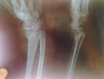 Перелом лучевой кости со смещением правой руки фото 2