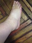 Болит нога после старого разрыва связок фото 1