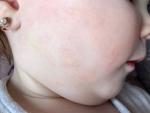 Ребенку 1 год появились высыпания на лице и теле фото 2