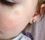Ребенку 1 год появились высыпания на лице и теле фото 3