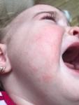 Ребенку 1 год появились высыпания на лице и теле фото 4