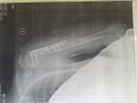 Перелом плечевой кости и прививка от ковид фото 1