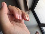 Ногти отслаиваются от кожи и высыпания на пальцах рук фото 1