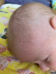 Сыпь на щеках младенца фото 1
