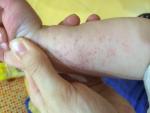 Аллергия у ребенка фото 1
