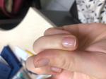 Пожелтение пальцев вокруг ногтя фото 3