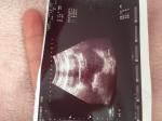 Когда можно планировать беременность при кисте левого яичника? фото 2