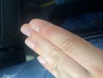 Уплотнения и трещины на пальцах рук фото 1