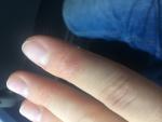Уплотнения и трещины на пальцах рук фото 2