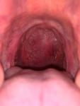 Болит горло после простуды или ковида фото 1