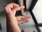 Ногти отслаиваются от кожи и высыпания на пальцах рук фото 2