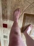 Удар ноги чуть выше колена с осложнениями фото 1