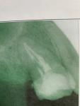Болит зуб после чистки каналов фото 1