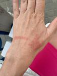Аллергия на руке, сильный зуд фото 1