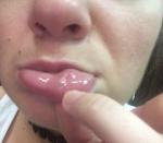 Шишка на внутренней стороне губы фото 1