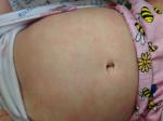Дисбактериоз ребенку 4 месяца на фоне атонического дерматита фото 2