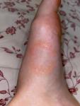 Красное круглое пятно на ноге фото 2