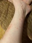 Сыпь на ногах после укуса комаров фото 2