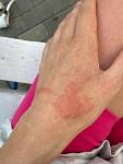 Аллергия на руке, сильный зуд фото 2