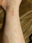 Сыпь на ногах после укуса комаров фото 1