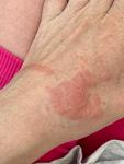 Аллергия на руке, сильный зуд фото 3