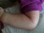 Сыпь на теле у ребенка фото 1