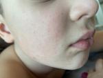 Сыпь на лице у ребёнка 8 лет фото 1
