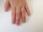 Деформация ногтей на руке фото 1