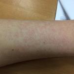 Сыпь по телу - аллергия или что-то серьезное? фото 1