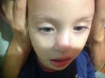 Прыщи на носу у ребёнка 3 лет фото 4