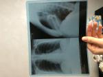 Рентген легких из-за боли в ребрах фото 1