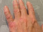 Сухость и шелушение кожи рук фото 3