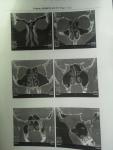 При томографии обнаружен вазомоторный ринит фото 2