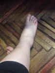Болит нога после старого разрыва связок фото 2