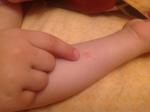 Скопление мелких розовых прыщиков на руке у ребенка фото 3