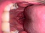Хронический Тонзиллит, сдавленность в горле фото 1