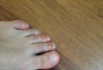 Ушиб указательного пальца ноги фото 1