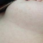 Бледные розово-коричневатые пятна под грудью и на спине фото 1