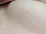Бледные розово-коричневатые пятна под грудью и на спине фото 2