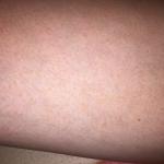 Мелкая коричневая сыпь на ногах фото 2