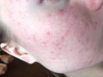 Сильная аллергия похоже диатез фото 1