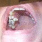 Что вы посоветовали бы с этим зубом делать? фото 1