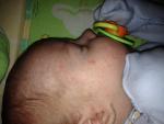 Аллергия или акне новорожденных фото 1