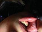 Небольшой прозрачный пузырёк на губе. Не болезненный фото 1