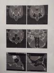 При томографии обнаружен вазомоторный ринит фото 3