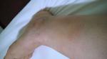 Опухлость на ног в виде тромба фото 3