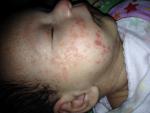 Сильная аллергия у младенца фото 1